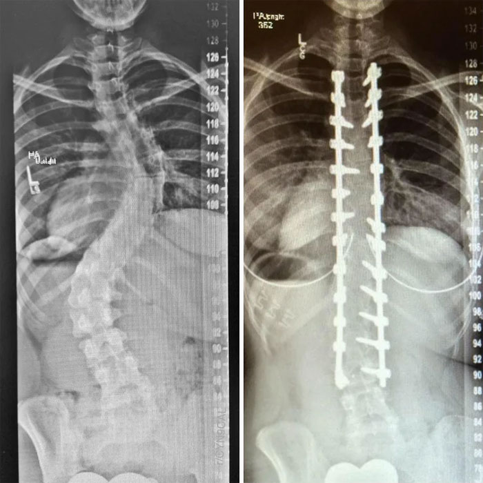X-Rays Of My Spinal Fusion Surgery Before And After