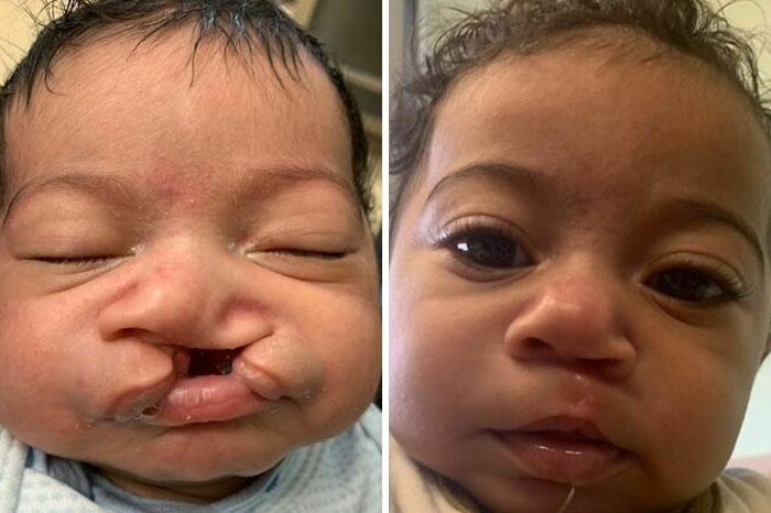 Antes y después de la cirugía de labio leporino