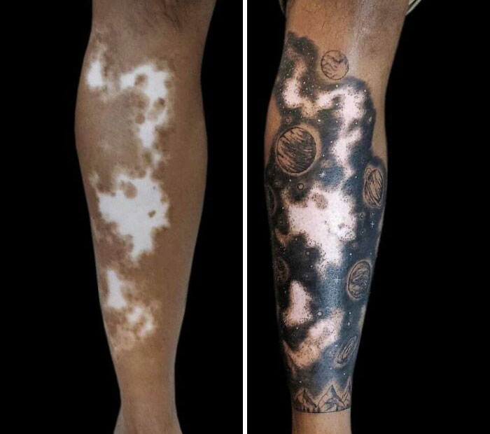 Convertir el vitiligo en un arte
