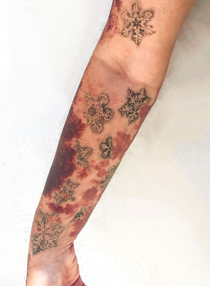 Tattooed snowflakes cover scars on a person's forearm, creating an artistic transformation.