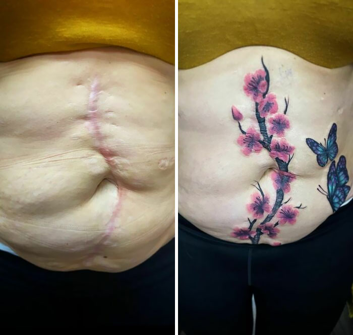 This Is A 40-Year-Old Scar And We Covered It With Some Cherry Blossoms And Butterflies