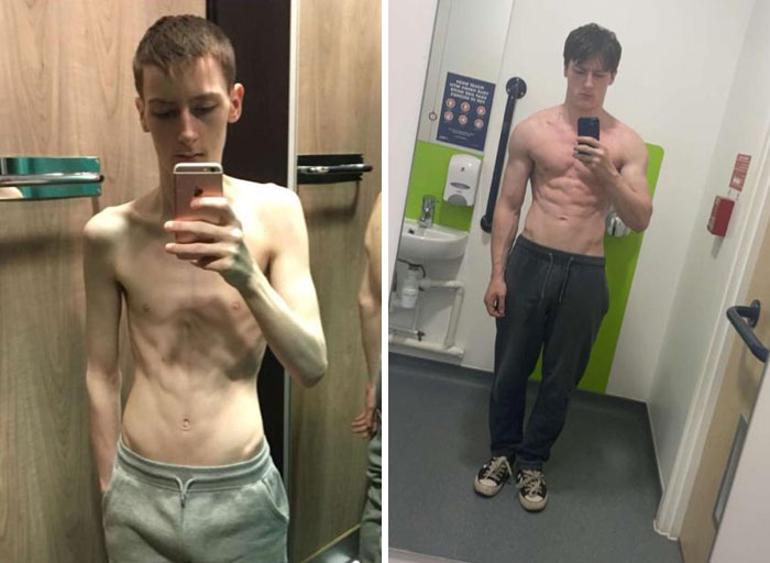 Beating Anorexia - 2-Year Transformation