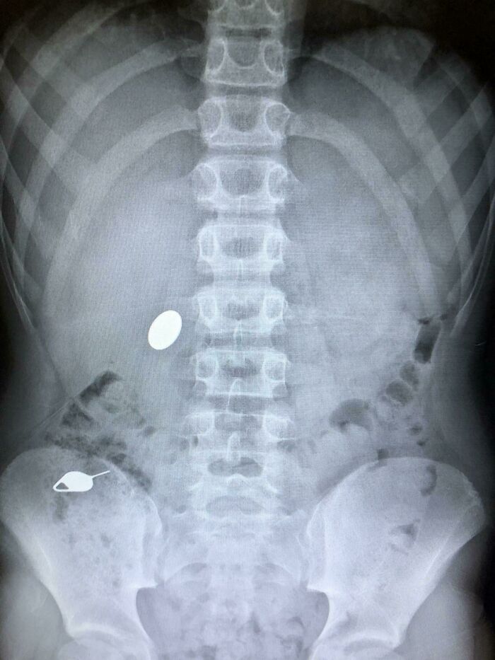 My Kid Swallowed A Penny While Showing His Little Brother How He Accidentally Swallowed A SIM Key The Day Before