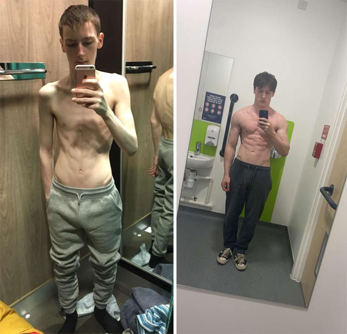 Beating Anorexia 2 Year Transformation
