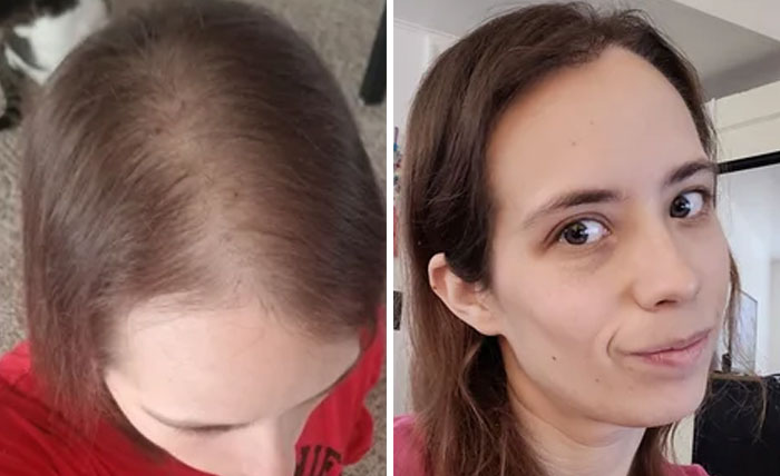 how much are hair plugs reddit