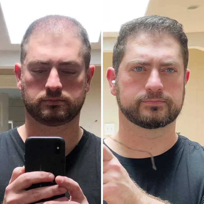 People Who Tried Out Hair Loss Treatments Are Sharing Their Results In This  Dedicated Online Community (30 Pics) | Bored Panda