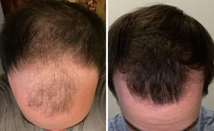 6 month hair growth male reddit