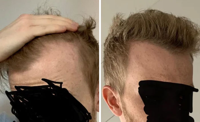 People Who Tried Out Hair Loss Treatments Are Sharing Their Results In This  Dedicated Online Community (30 Pics) | Bored Panda