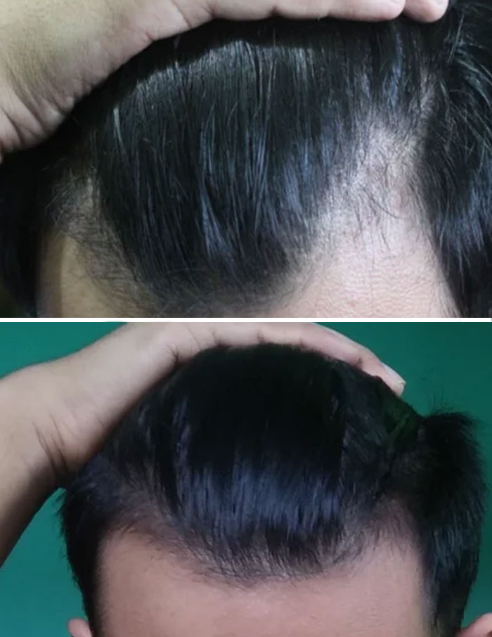 People Who Tried Out Hair Loss Are Sharing Results In Online Community (30 Pics) | Bored Panda