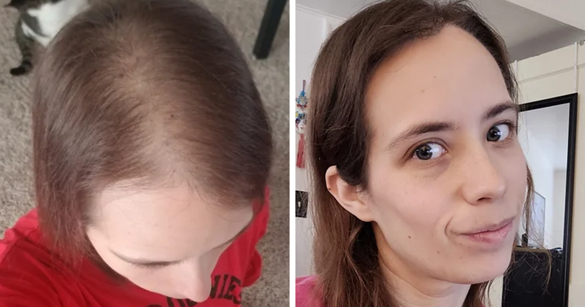 klæde sig ud prinsesse Modtager People Who Tried Out Hair Loss Treatments Are Sharing Their Results In This  Dedicated Online Community (30 Pics) | Bored Panda