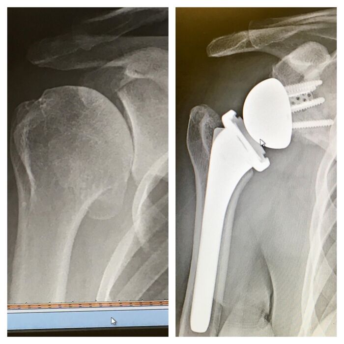 Before And After A Total Reverse Shoulder Replacement.