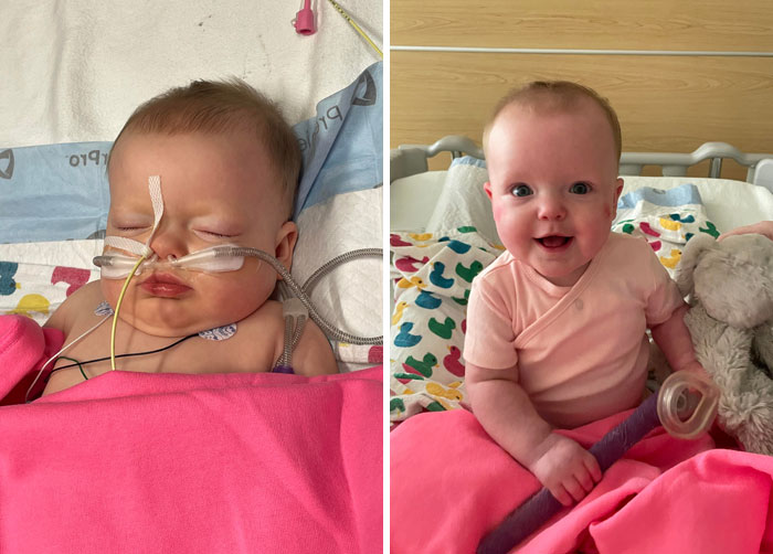 Before And After: My Daughter Battling A Combination Of RSV, Rhino Enterovirus, And Bacterial Pneumonia. She Almost Died, But She’s Now Home Safe And Sound