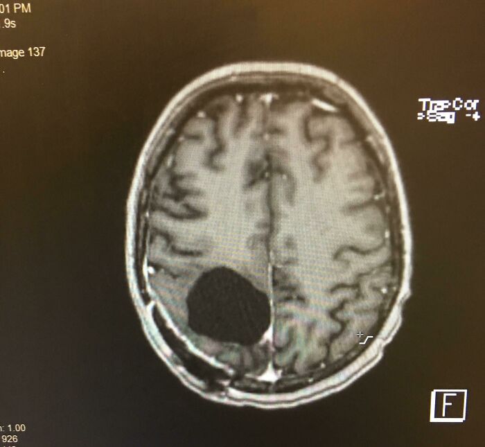 I Had A Brain Tumor Removed, And Now I’m A Bit Absent Minded