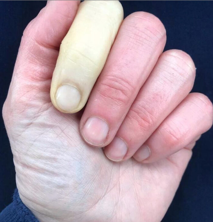 Raynaud's Phenomenon. It Is A Medical Condition In Which Spasm Of Arteries Cause Episodes Of Reduced Blood Flow