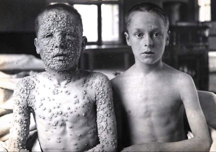 This Photograph Shows The Dramatic Differences In Two Boys Who Were Exposed To The Same Smallpox Source – One Was Vaccinated, One Was Not.
