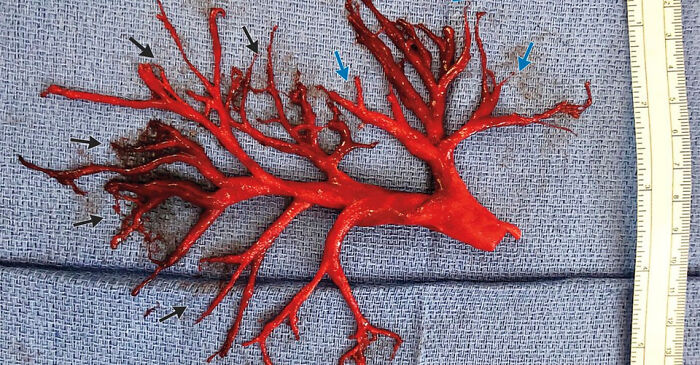 Man Coughs Up Huge Blood Clot Shaped Like A Lung - Full Case