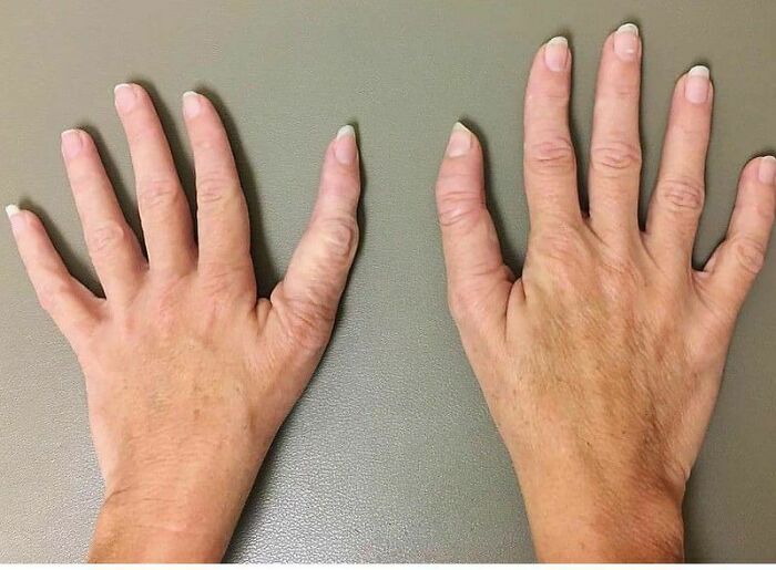 Triphalangeal Thumb (Tpt) Is A Congenitalmalformation Where The Thumb Has Three Phalanges Instead Of Two. The Extra Phalangeal Bone Can Vary In Size From That Of A Small Pebble To A Size Comparable To The Phalanges In Non-Thumb Digits