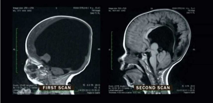 Mri Scans Of A Boy Born With Only 2% Of His Brain And 2 Years Later. His Brain Regrew To 80% Of Its Intended Size And He Only Suffers From Comparably Small Cognitive Deficits Today