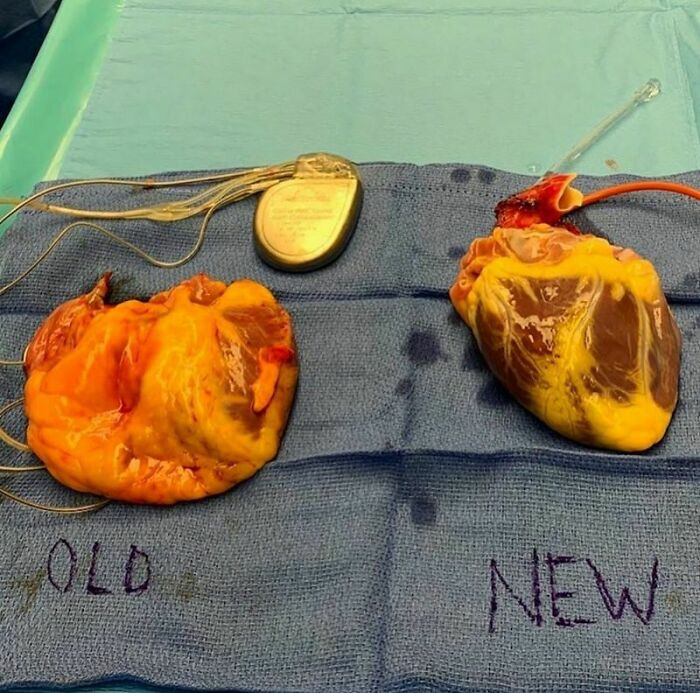 Transplante de corazón: el viejo y malo a la izquierda y el nuevo a la derecha