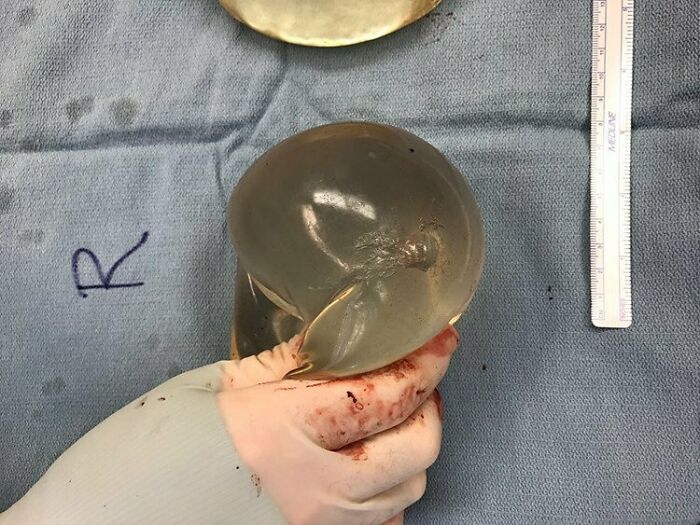 Breast Implant Saves A Life!a Recent Study Published In Sage Medical Journal Describes The Case Of A 30-Year-Old Woman Whose Silicone Breast Implant Deflected A Bullet, Saving Her Life In The Process - Medical Case