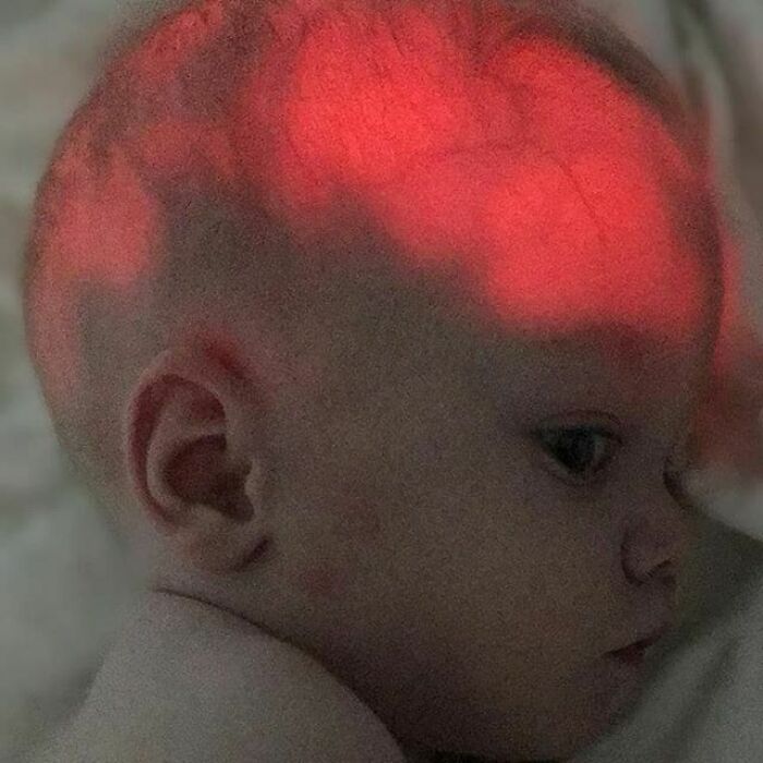 Transilluminating Newborn’s Head, Affected By Herpes Simplex Virus (Hsv), Leading To Encephalitis And Causing Extensive Damage To The Cerebral Tissue Which Then Gets Replaced By The Saclike Accumulation Of Fluid, Thus The Transillumination - Full Case
