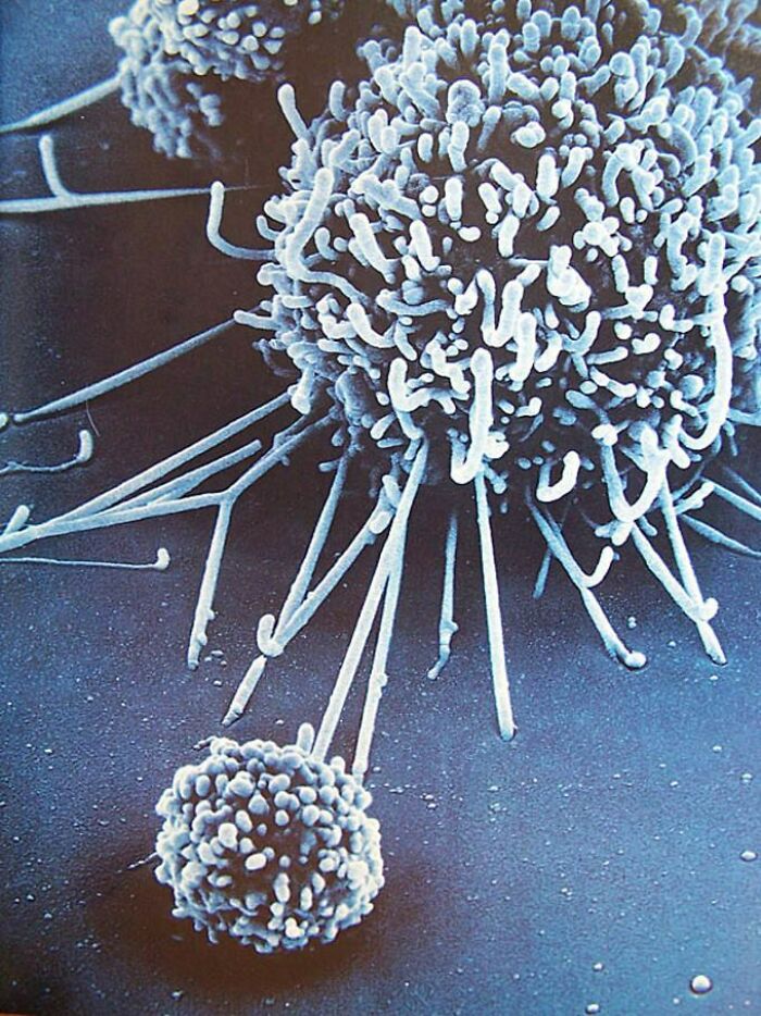 ‌a Scanning Electron Micrograph Of A Natural Killer Cell Facing Off Against A Larger Cancer Cell