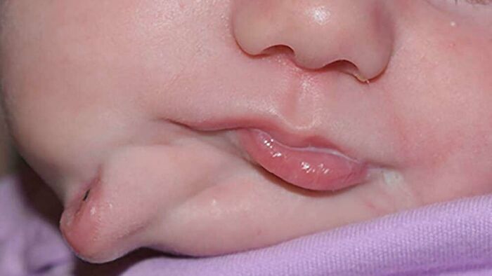 Baby Born With Two Mouths!- Medical Case
