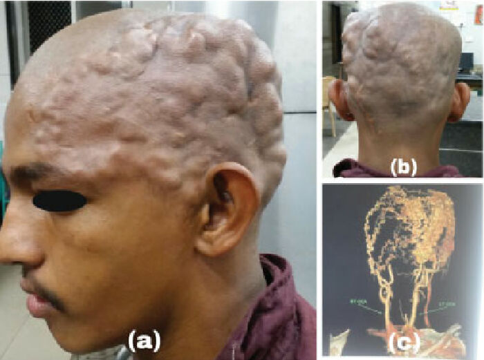Cirsoid Aneurysm: Complicated Vascular Network In Scalp - Medical Case