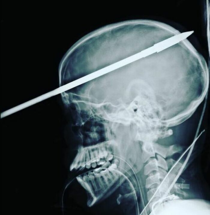 16 Year Old Boy Survived After Being Implanted In The Head By A Fishing Spear