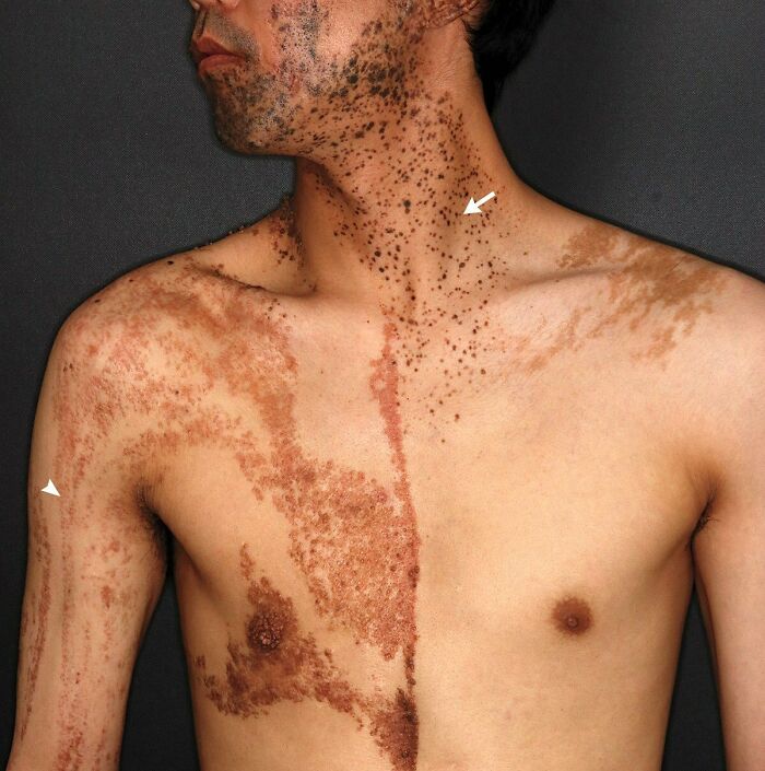 A 37-Year-Old Man Came To The Dermatology Clinic With Complaints Of Skin Lesions Which Were Present Since Birth - Medical Case