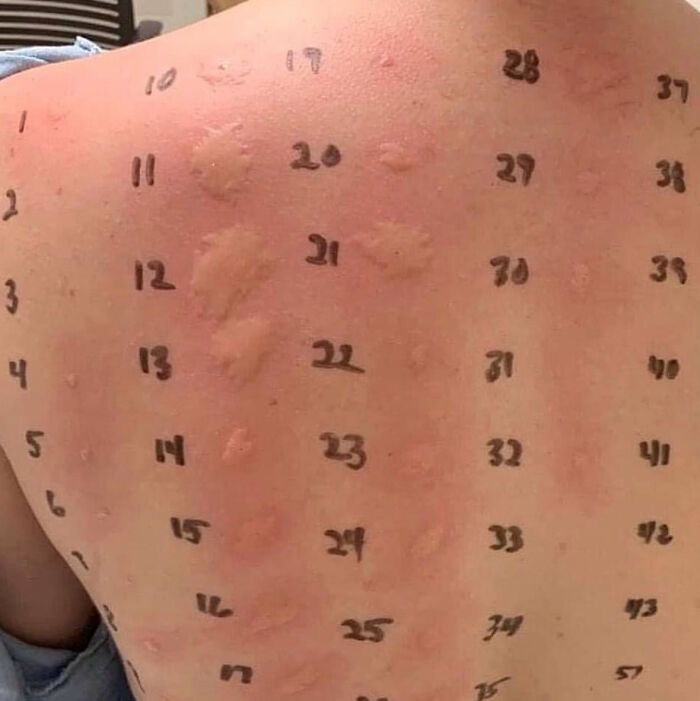 Skin Tests For Allergies