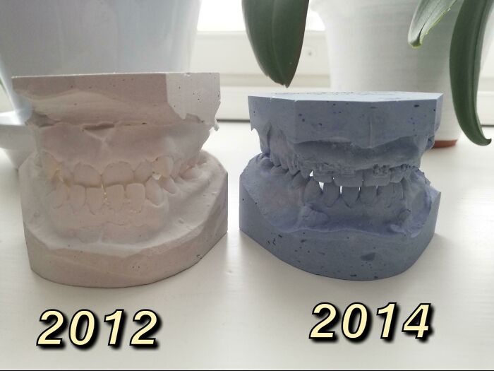 How My Underbite Was Fixed Over The Course Of Two Years By Constant Tension From Rubberbands Attached To Hooks That Were Screwed Into My Jawbones