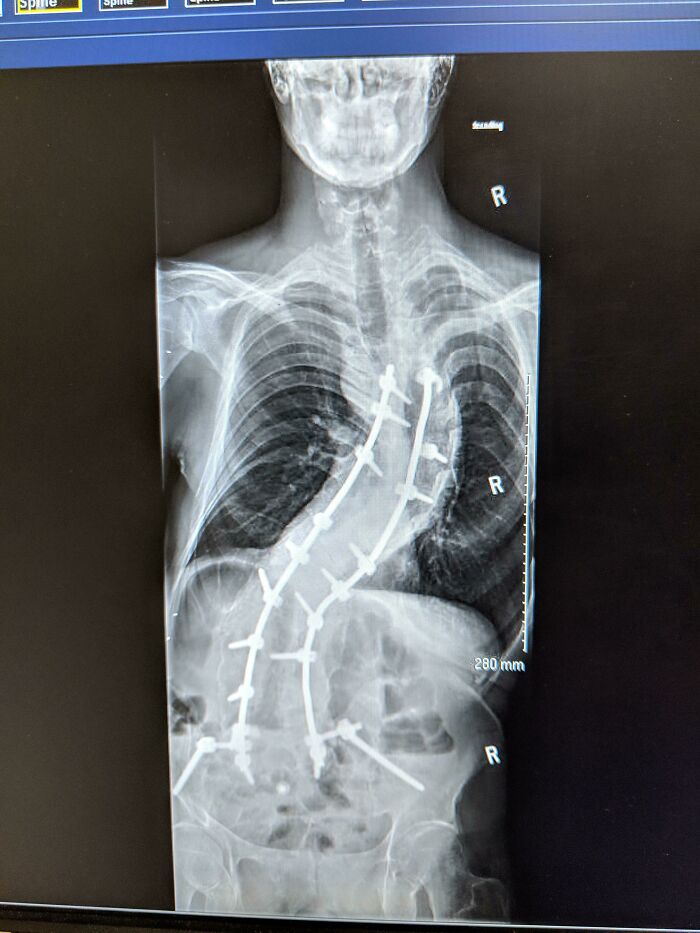 2 Years Post Op Spinal Fusion. Yeah, That's Me