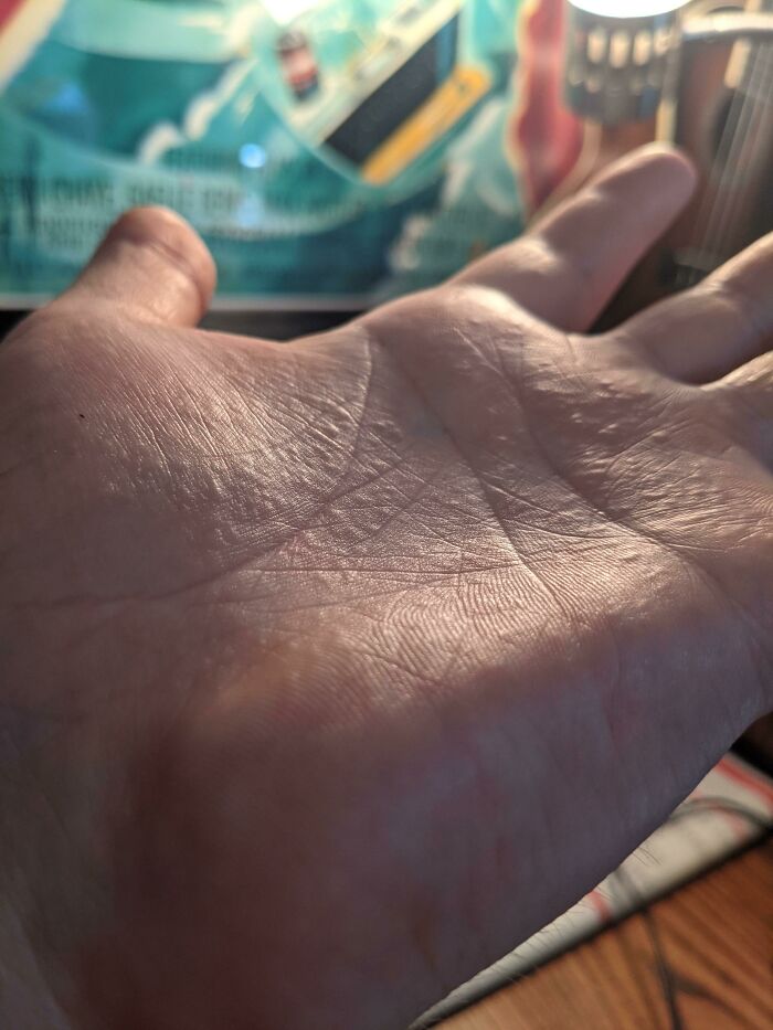 One Of My Kids Brought Poison Ivy Into The House, Now My Hands Look Like This. Every Bump Is A Blister