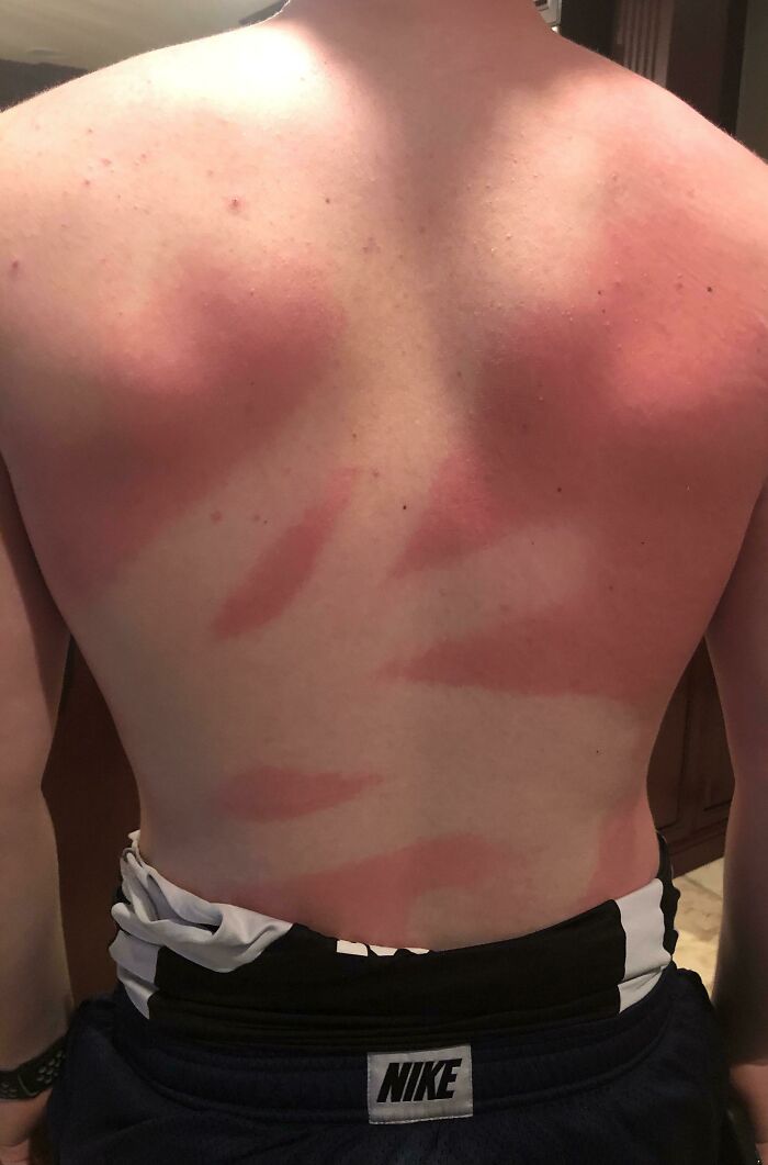 Asked My Friend To Spray Sunscreen On My Back... Not The Most Even Coat