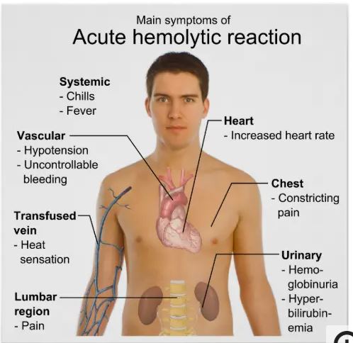 acute-hemolytic-reaction-61859918b61cc.jpg