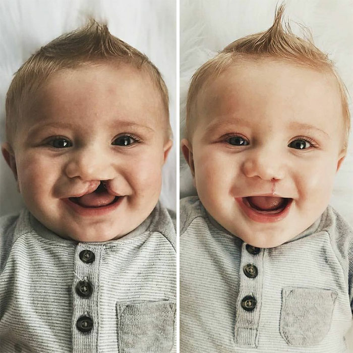 Cleft Lip And Cleft Palate. Two Weeks Post Surgery