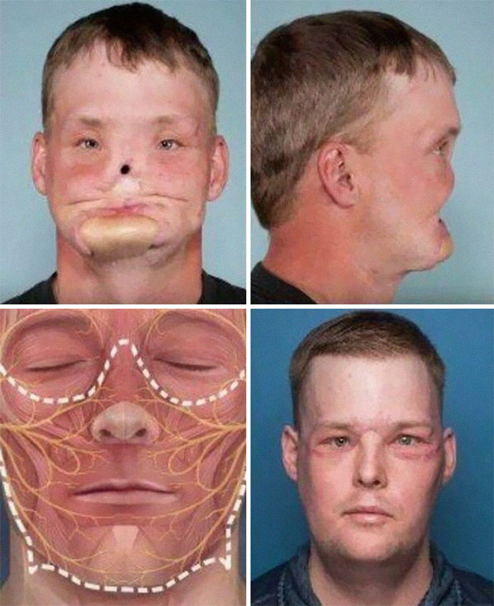 Incredible Well Performed Face Transplant