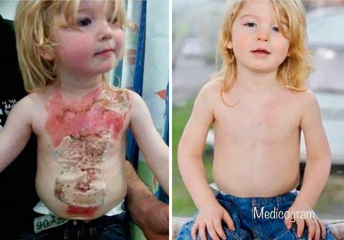 Quemaduras de 2º grado antes y después del tratamiento "spray-on skin"