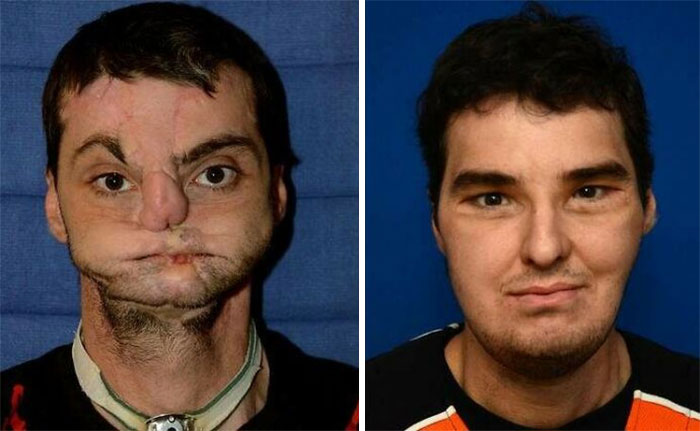 Antes y después de un transplante facial