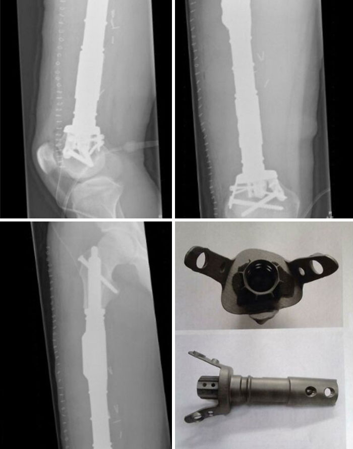 Según mi médico, fui la 1ª persona en el mundo en recibir un hueso impreso en 3D en 2014. Sin ello, habría perdido la rodilla