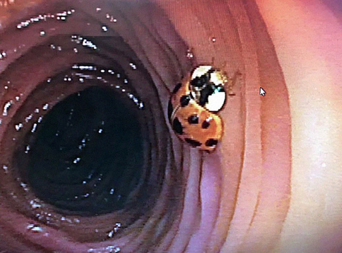 Ladybug Found In The Transverse Colon During Screening Colonoscopy