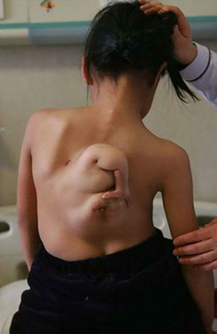 A Rare Case Of Parasitic Twin Seen In An 11 Year-Old Girl Named Yin Xin, Of Changzhi Town, Shanxi Province, China In 2007