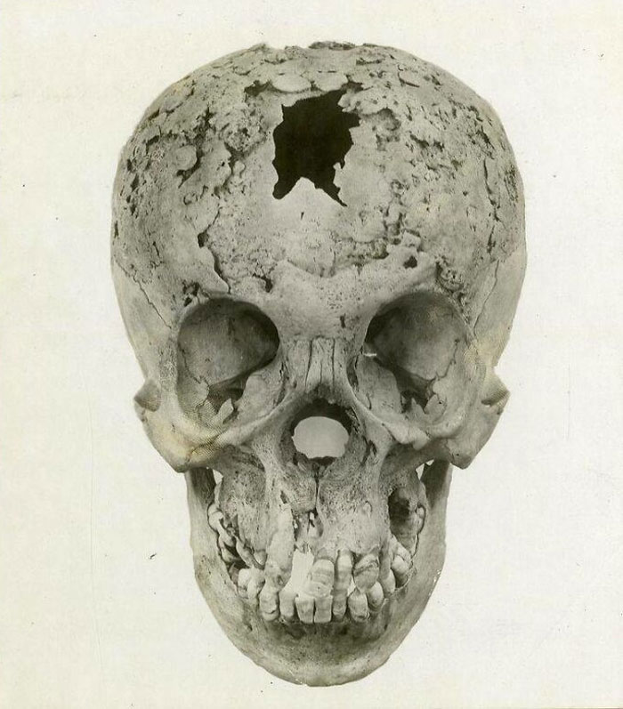 Syphilis Of The Skull. Venereal Diseases