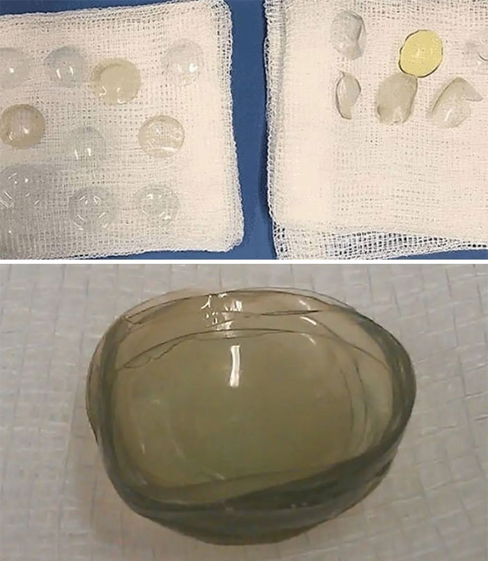 Doctors Find 27 Contact Lenses Stuck In 67-Year-Old Woman’s Eye
