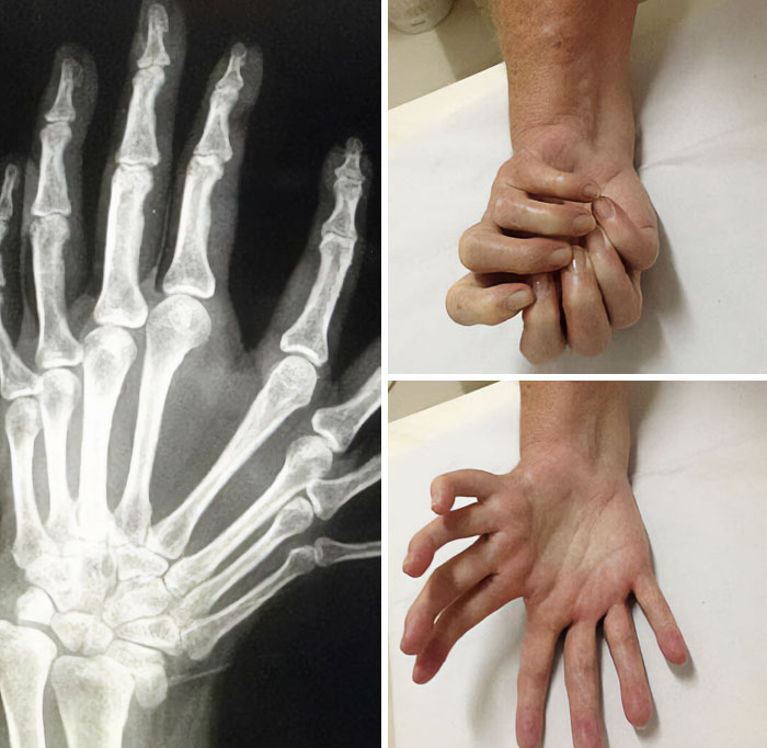 This Condition Is Called Mirror Hand Syndrome, Less Than 100 Cases Have Ever Been Diagnosed And The Cause Is Still Unknown