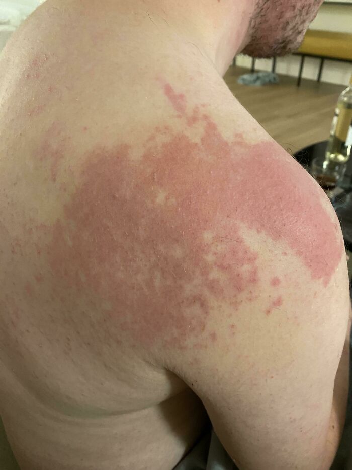Sudden Red Rash After Drinking Cheap Alcohol