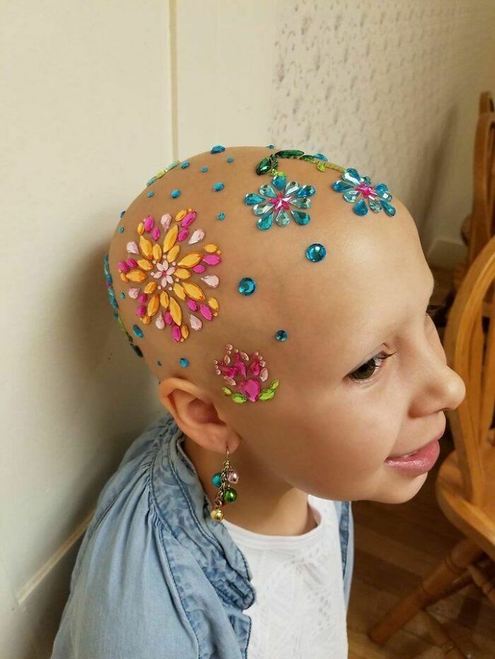 7-Year-Old Does Not Let Alopecia Stop Her From Celebrating Her School's "Crazy Hair Day'