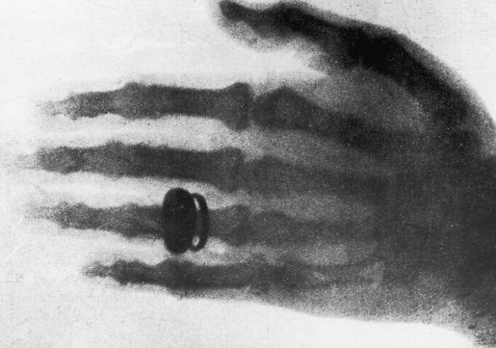 On This Day In 1895, German Scientist Wilhelm Conrad Rontgen Becomes The First Person To Observe X-Rays. This Finding Occurred Accidentally As He Was Testing To See If Cathode Rays Could Pass Through Glass. He Noticed A Glow From A Nearby Chemically Coated Screen And Labeled This An X-Ray Because Of Its Unknown Nature. Rontgen Then Learned That The X-Ray Can Penetrate Human Skin But Not Higher Density Parts Like A Bone And Can Be Photographed. This Was A Major Finding In The Medical World As Doctors No Longer Needed To Open A Body To See Inside The Human Body.