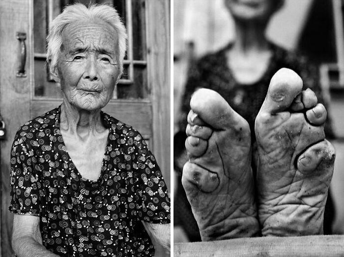 Chinese Foot Binding Began In The 10th Century, As A Way To Impress The Emperor In His Favorite Dance. Eventually, The Tradition Of Foot Binding Spread And It Was Perceived As A Sign Of Beauty And Wealth. It Was Believed That In Order To Have A Good Marriage, Girls From The Age Of 4 To 9 Had To Have Their Feet Bound. Foot Binding Caused Infections Which Rotted Toes And Foot Deformity. In 1912, China Banned The Tradition.